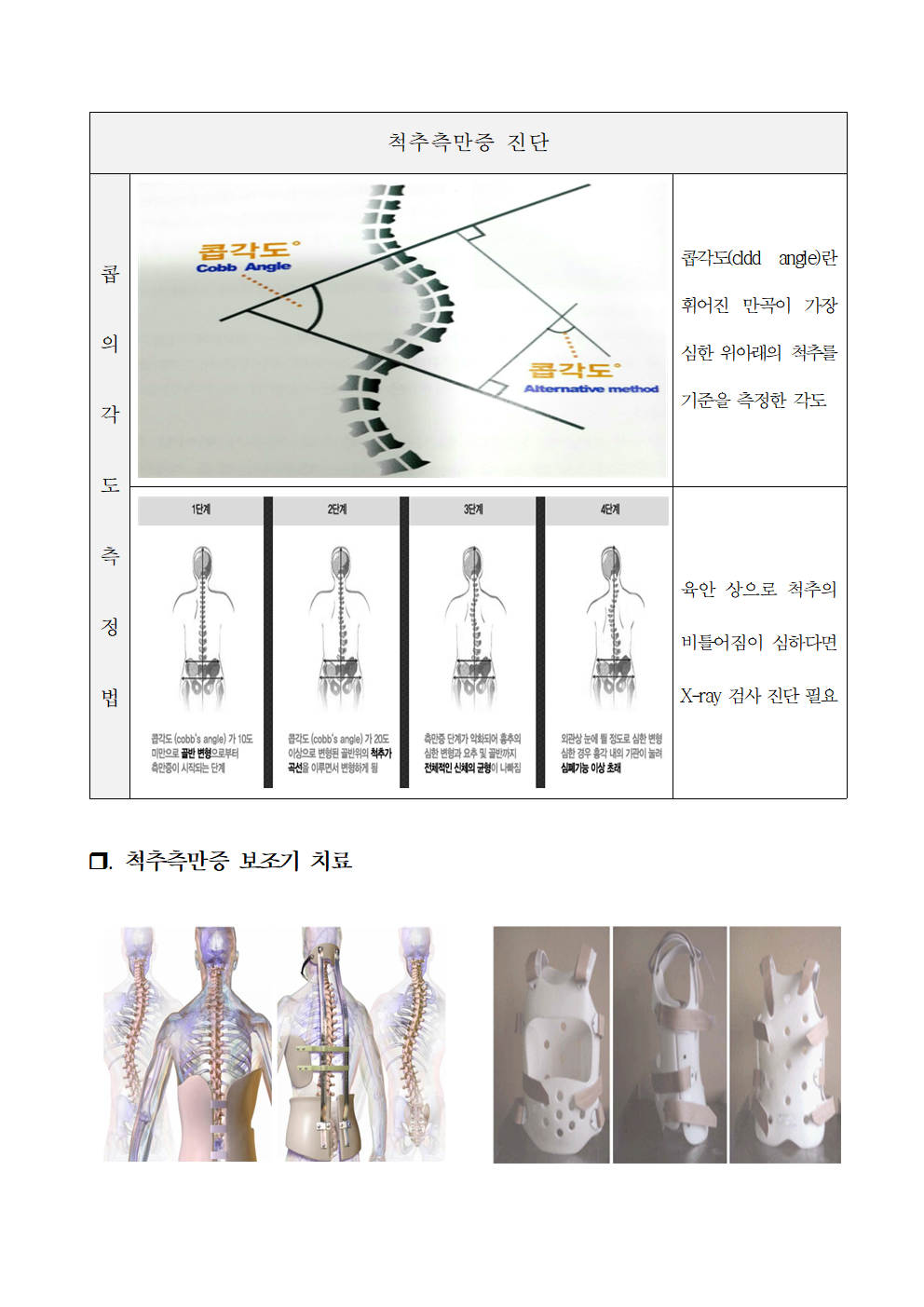 2023_척추옆굽음증사전교육자료004