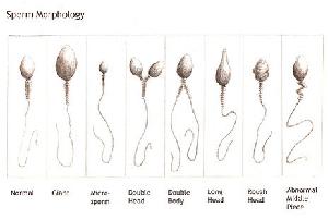 비정상 정자.JPG