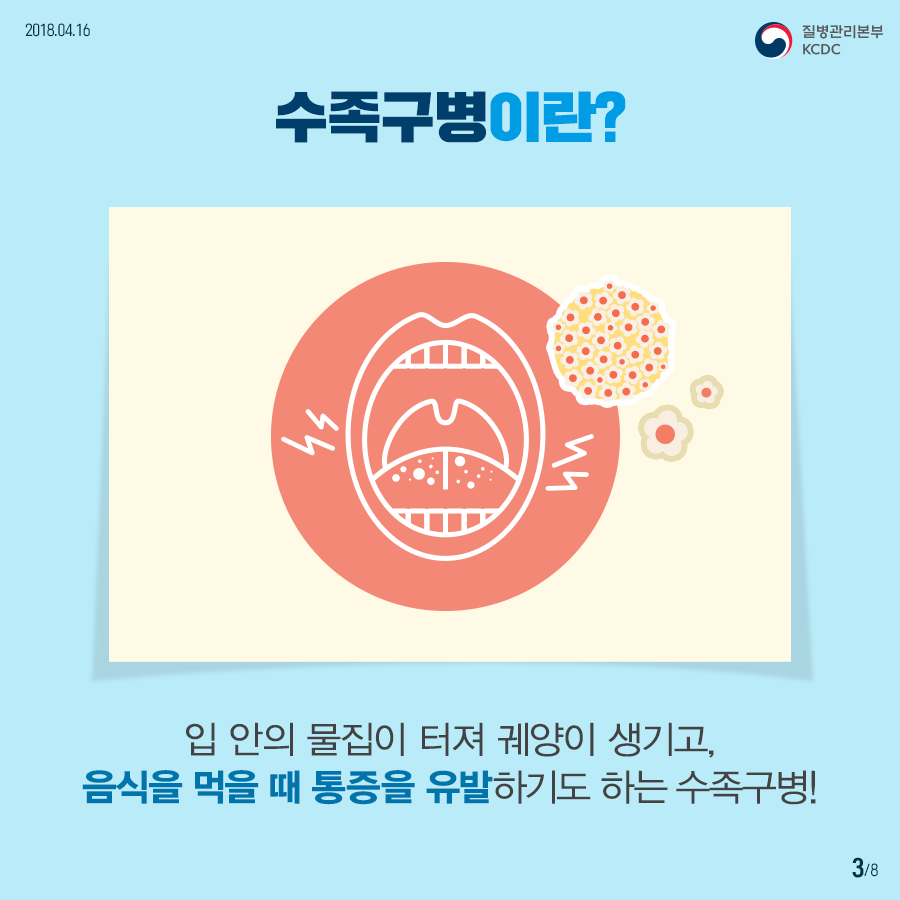 사본 -180416_수족구병_02속지