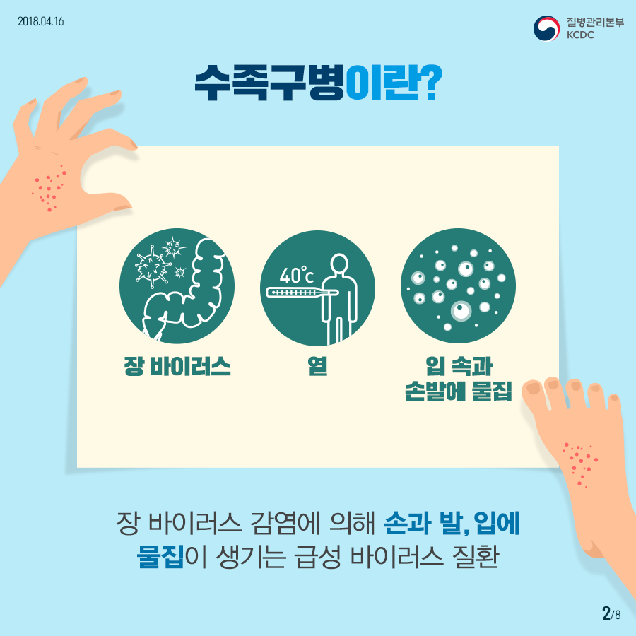 사본 -180416_수족구병_01속지