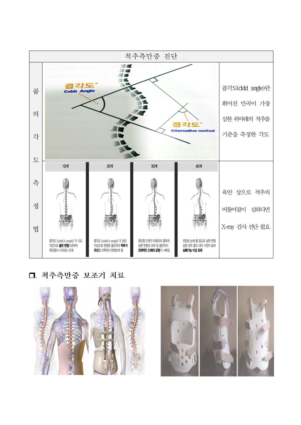 척추옆굽음증 검사 사전교육자료004